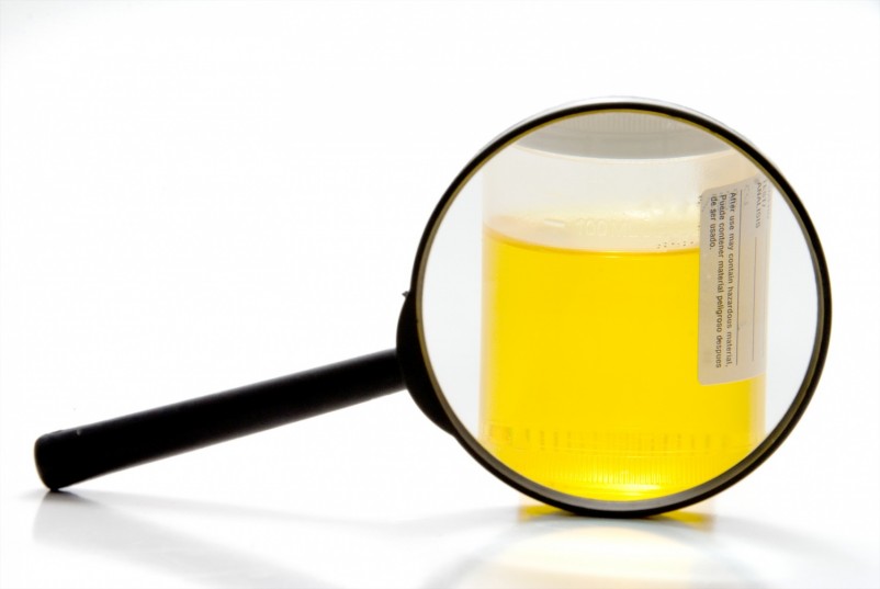 A fresh urine sample in a medical container.
